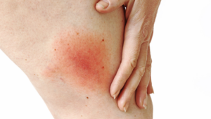 Inflamed red rash on knee with hand